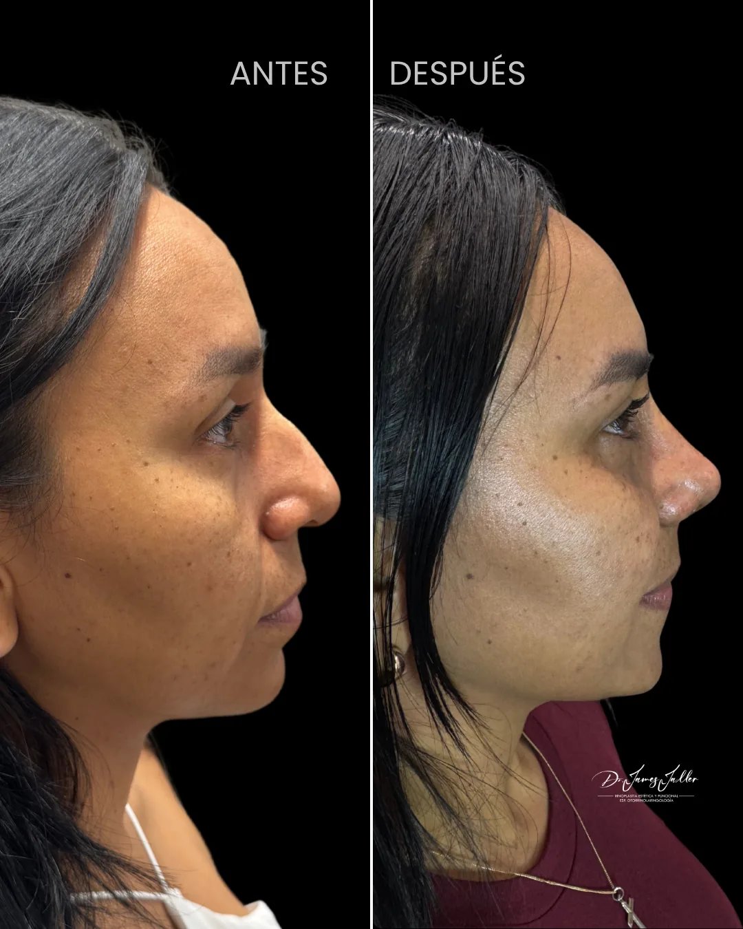 Antes y después de rinoplastia — vista lateral
